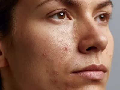 Macro skin close-up of small inflamed papules and blocked pores reflecting acne around mouth on the chin