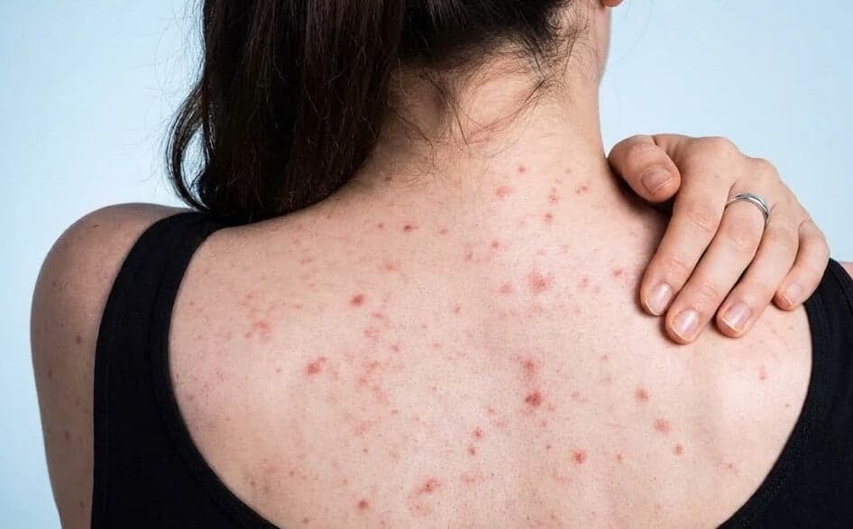 Bacne Scars Treatment skin texture image for Prescription Skin
