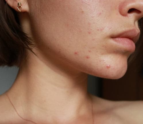 Macro close-up of skin texture with mild flaking and redness linked to retinol purging