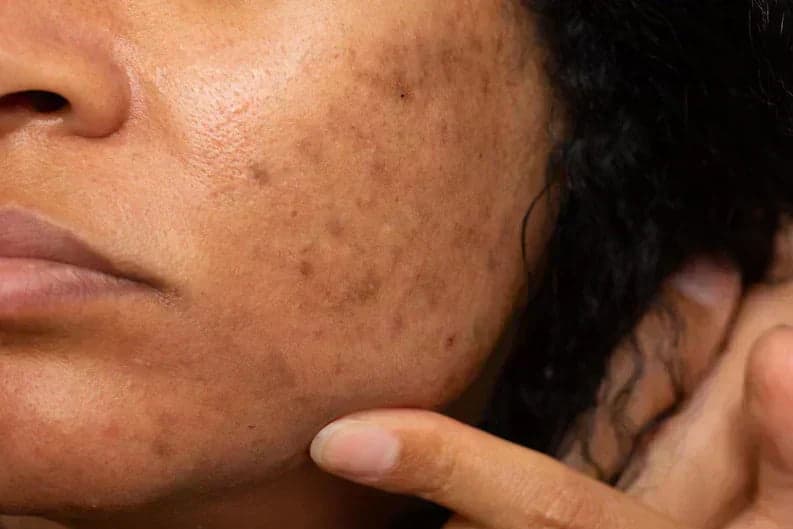 Macro close-up of cheek skin with uneven brown pigment patches, illustrating hydroquinone 2 vs 4 australia strengths