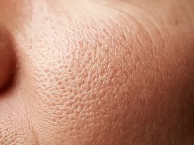 Macro close-up of skin texture showing blackheads and surface congestion linked to clogged pores on face